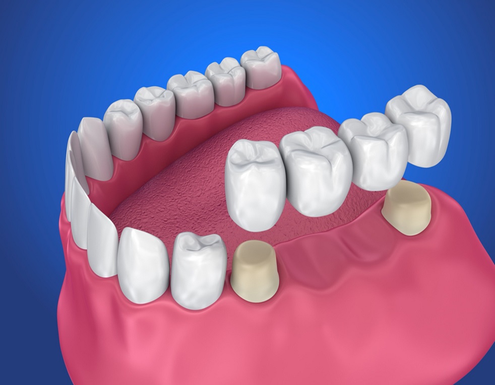 common-dental-bridge-complications 1